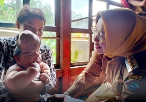 Mata Bupati Erlina Berkaca-kaca, Lihat Balita Terlahir Tanpa Tempurung Kepala